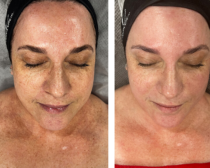 About Lymphatic Drainage Facial