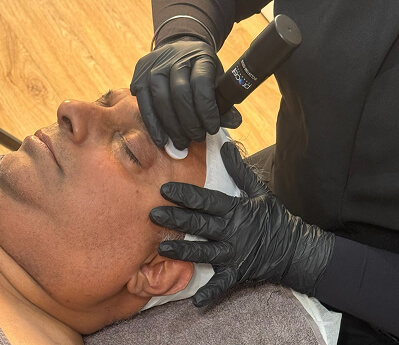 ProCell Microchanneling for Skin